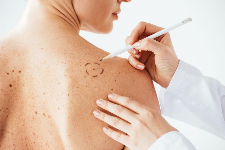 Cáncer de piel: Cómo reconocer lunares malignos