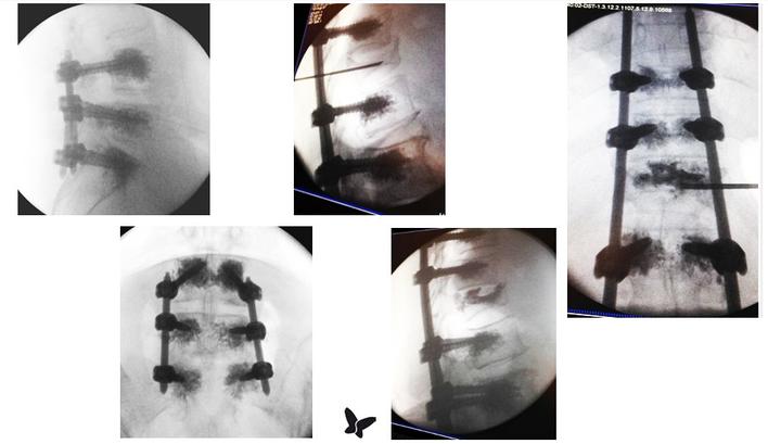 Según los profesionales, las incisiones son más pequeñas y los pacientes suelen recuperarse más rápido. ¿Qué diferencias mantiene con una cirugía tradicional? El doctor Alejandro Vázquez te lo cuenta.