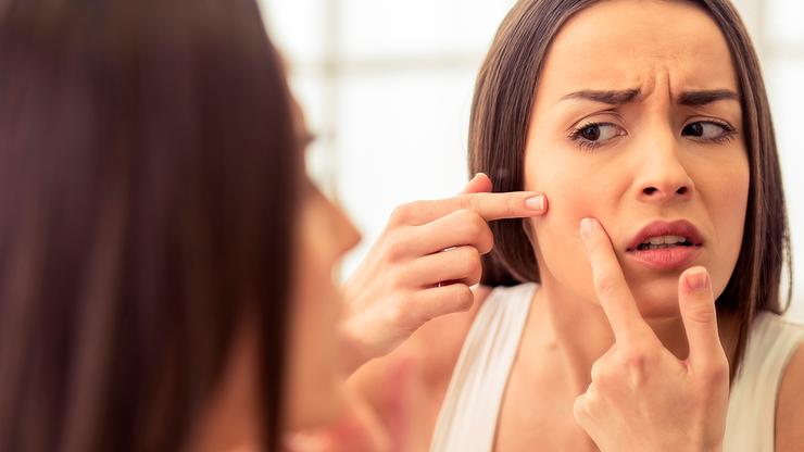 Acné: ¿A qué personas afecta y cuáles son sus causas?