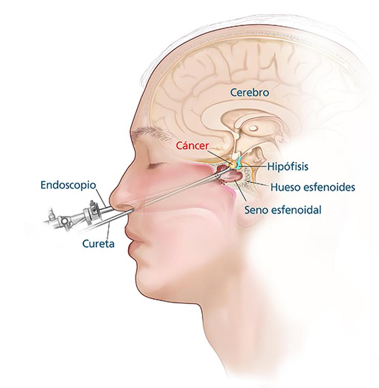 “La endoscopía de base de cráneo permite al paciente una recuperación más rápida”