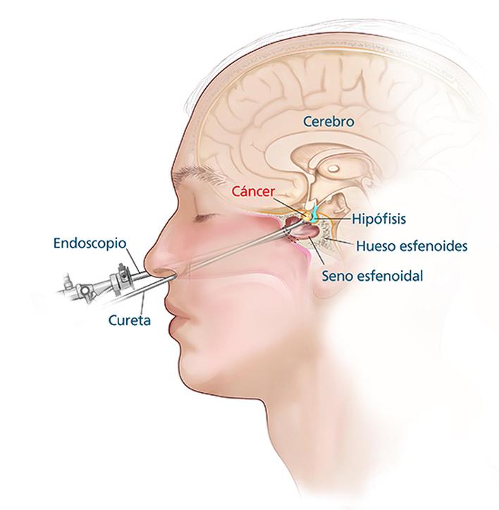 Así se expresó el neurocirujano Javier Lizundia sobre el innovador método de cirugías endoscópicas que se emplea en el Hospital Santa Isabel de Hungría. Conocé qué patologías pueden tratarse, en la nota. 